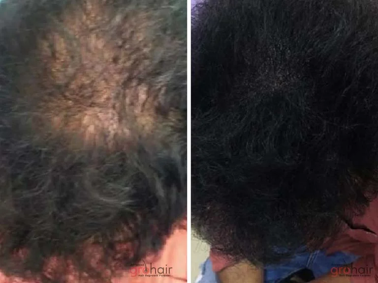 Before and After 1