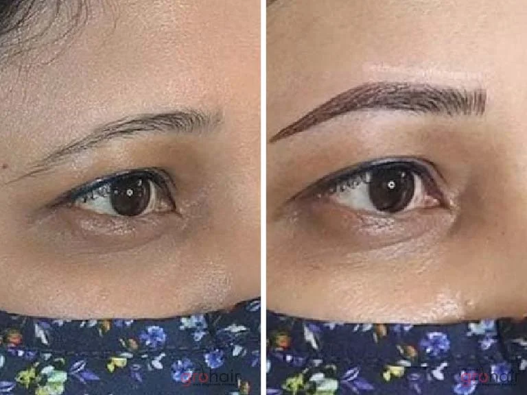 Before and After 4