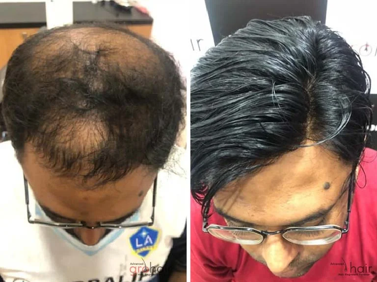 Before and After 2