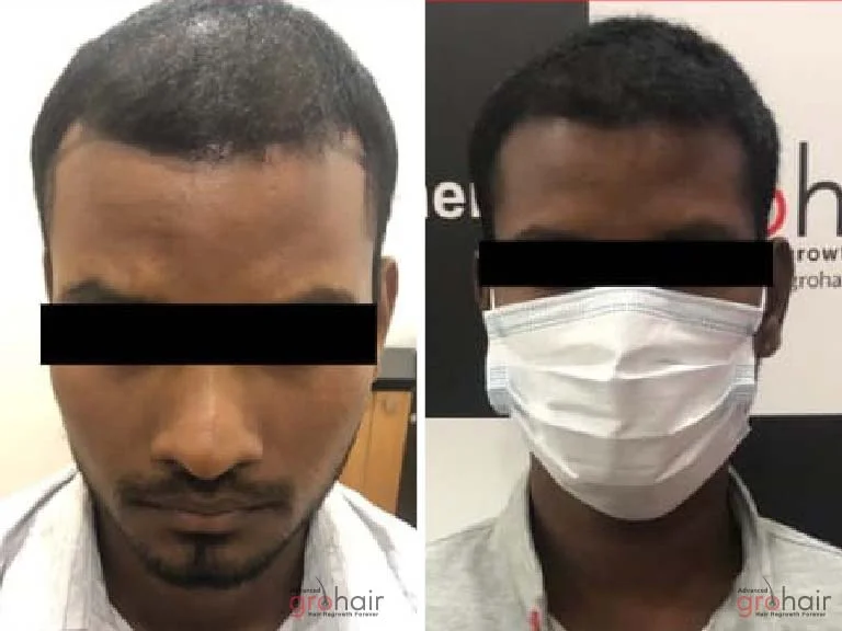 Before and After 3