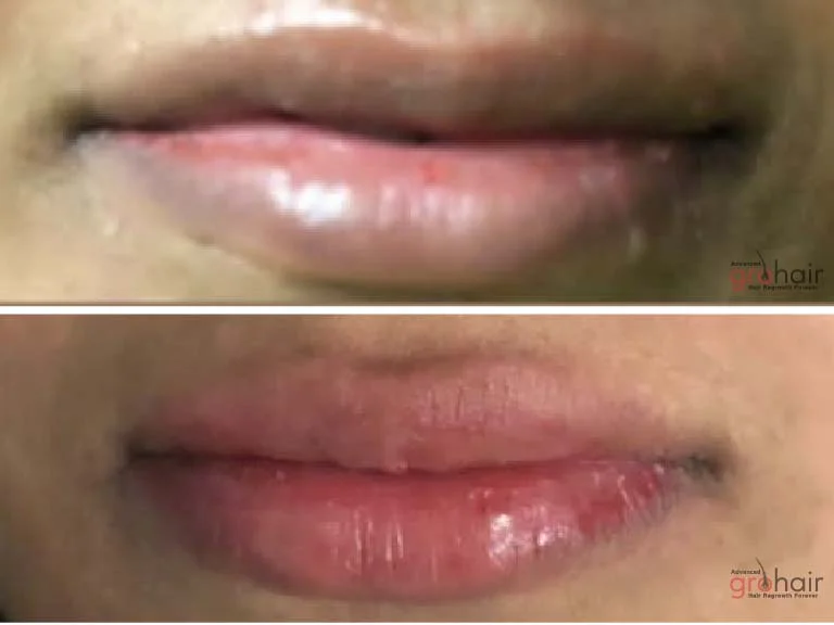 Before and After 2