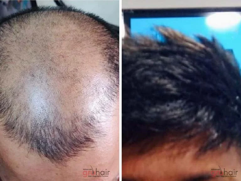 Before and After 4